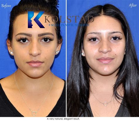 <b>Rhinoplasty</b> is the surgical revision of the size or shape of the nose. . Mexico rhinoplasty surgeons